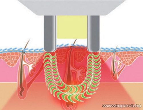 Homedics Mé My Elos Plus villanófényes és rádiófrekvenciás tartós szőrtelenítő készülék - készlethiány